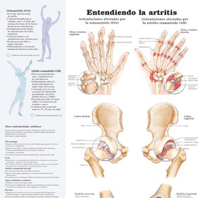 Poster laminado  medidas 66 cm x 51 cm entendiendo artritis